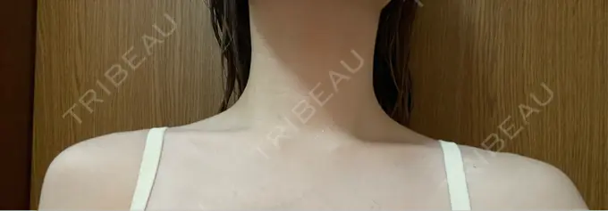 ボトックス（口角） / ボトックス（肩） TCB東京中央美容外科 浜松院 DAY 4 メイン用