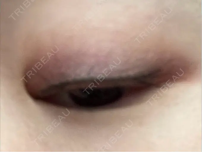 アートメイク（アイライン） BISIN GINZA CLINIC AFTER メイン用