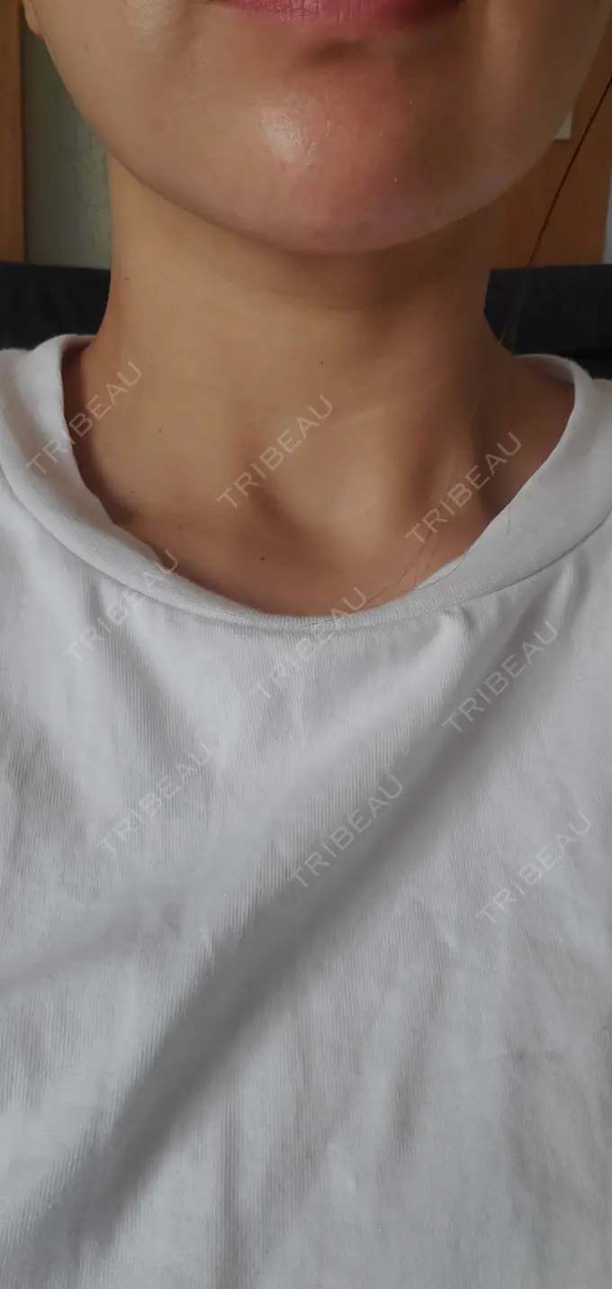 ヒアルロン酸注入（あご） / シワ取りボトックス / ボトックス（額） 湘南美容クリニック 浜松院 DAY 2 メイン用