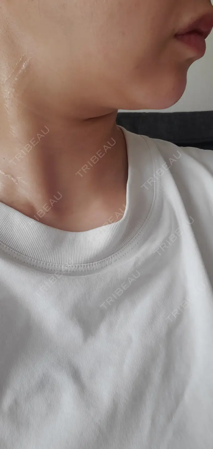 ヒアルロン酸注入（あご） / シワ取りボトックス / ボトックス（額） 湘南美容クリニック 浜松院 DAY 3 メイン用