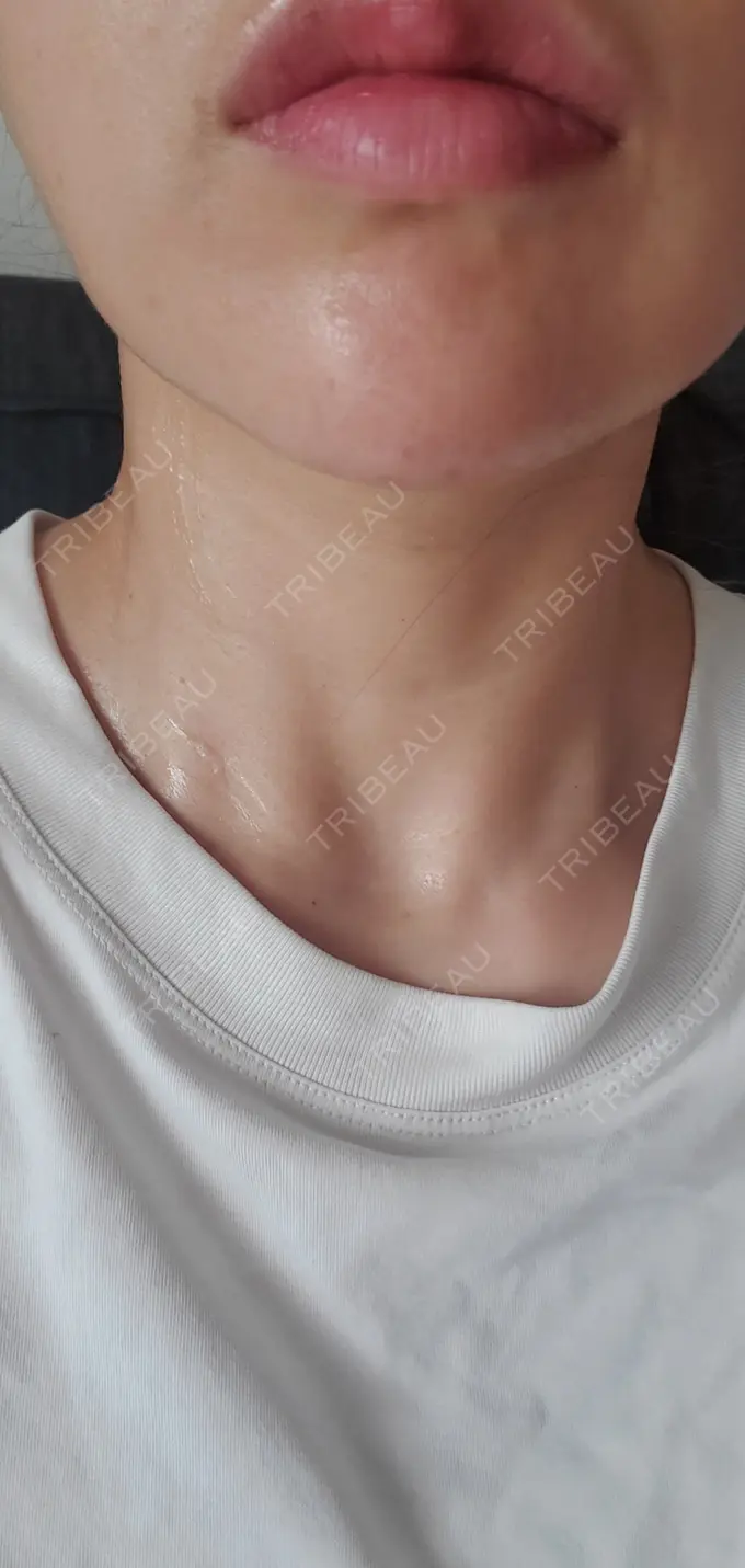 ヒアルロン酸注入（あご） / シワ取りボトックス / ボトックス（額） 湘南美容クリニック 浜松院 DAY 3 メイン用