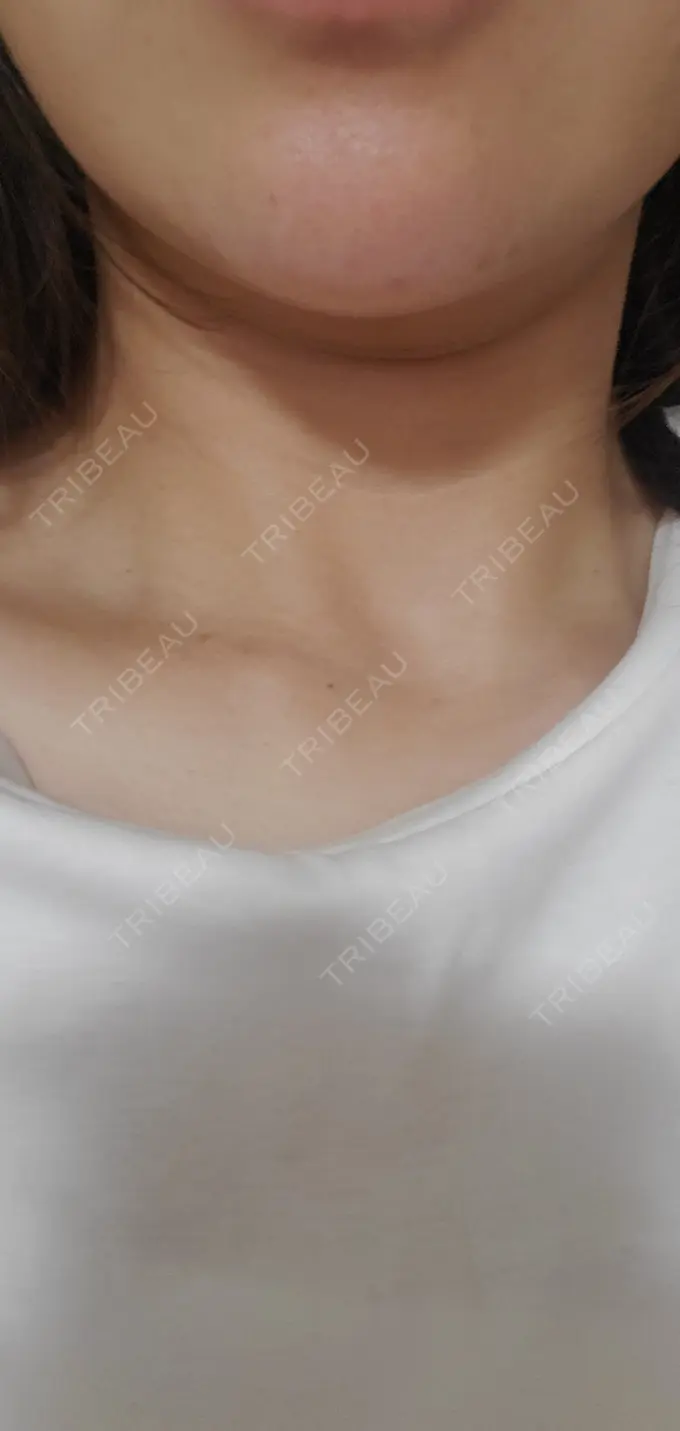 ヒアルロン酸注入（あご） / シワ取りボトックス / ボトックス（額） 湘南美容クリニック 浜松院 DAY 4 メイン用