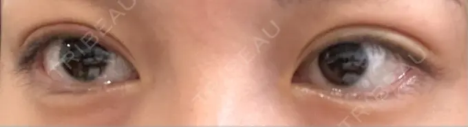 二重埋没 HAAB×DREAM BEAUTY CLINIC 大阪梅田院 AFTER メイン用