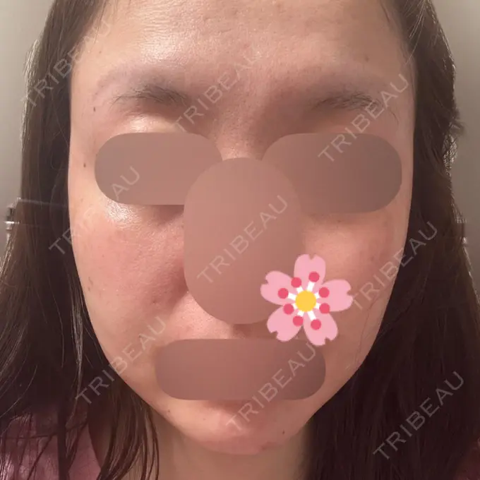 インディバ（顔） Casa de GRACIA GINZA 【カーサデグラシアギンザ】 DAY 25 メイン用