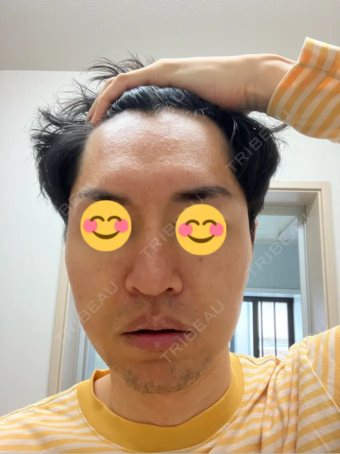 ピコレーザートーニング（美白・肝斑） / フラクショナルレーザー（毛穴・ニキビ跡） ルラ美容クリニック 広島院 DAY 3 メイン用