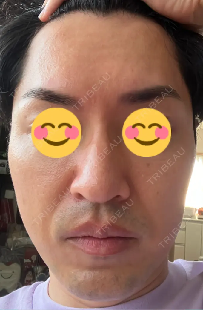 ピコレーザートーニング（美白・肝斑） / フラクショナルレーザー（毛穴・ニキビ跡） ルラ美容クリニック 広島院 DAY 4 メイン用