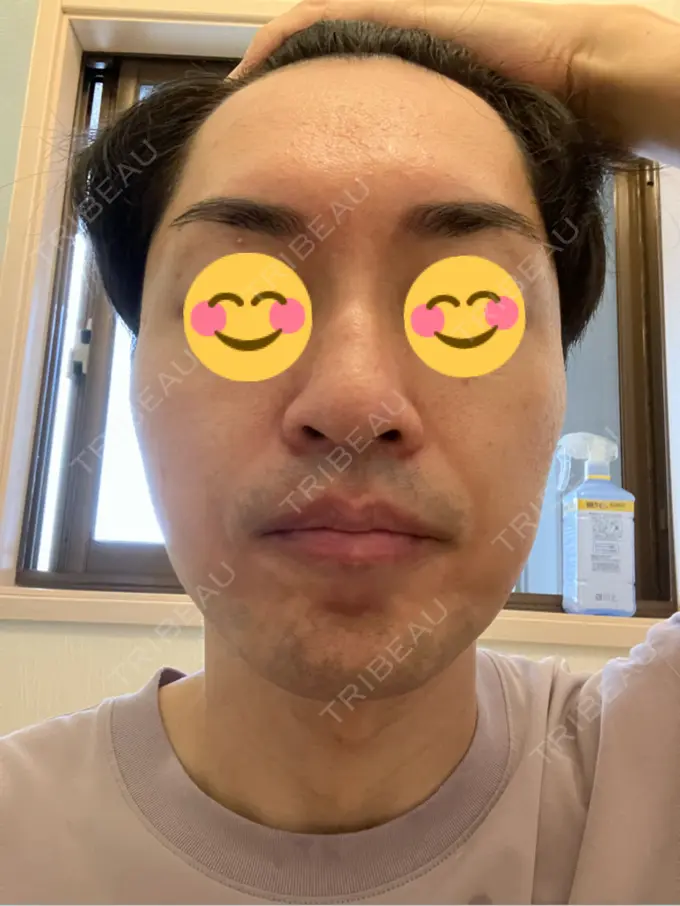 ピコレーザートーニング（美白・肝斑） / フラクショナルレーザー（毛穴・ニキビ跡） ルラ美容クリニック 広島院 DAY 5 メイン用