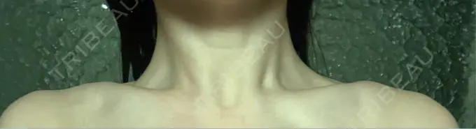 ボトックス（肩） APスキンクリニック銀座 DAY 8 メイン用