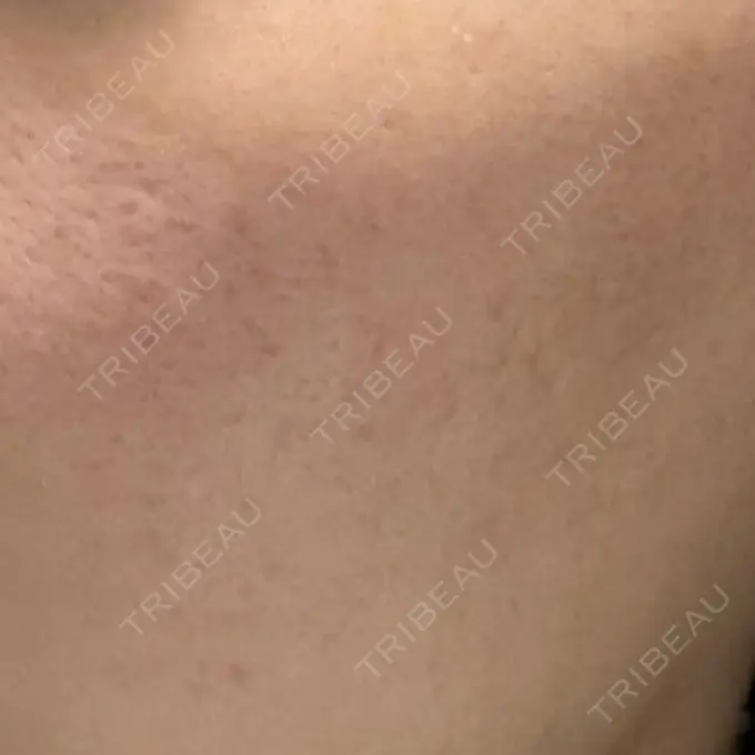 サブシジョン / ニキビ治療 ライブリークリニック 浜松町院 AFTER メイン用