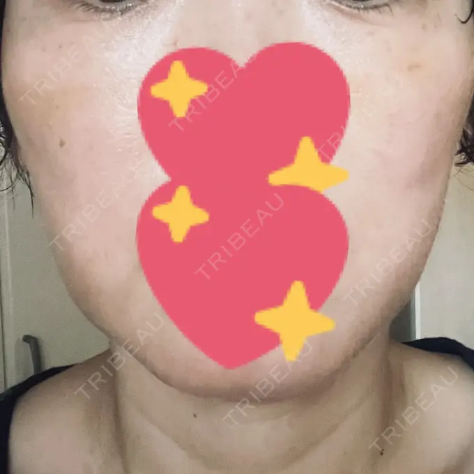 肌育注射（ジュベルックなど） B-LINE CLINIC 大阪院 DAY 10 メイン用