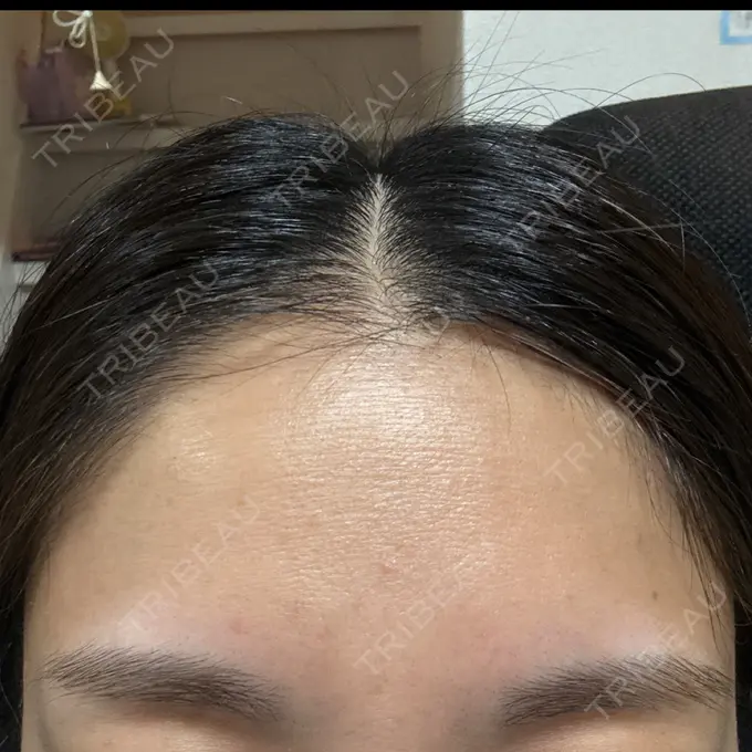 ボトックス（眉間） ルラ美容クリニック 高田馬場院 DAY 2 メイン用