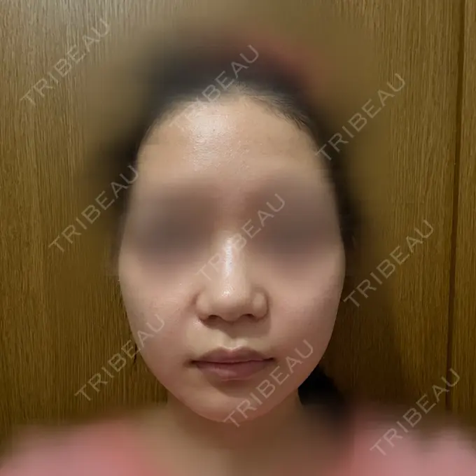 肌育注射（ジュベルックなど） TRUE DESIGN CLINIC DAY 21 メイン用