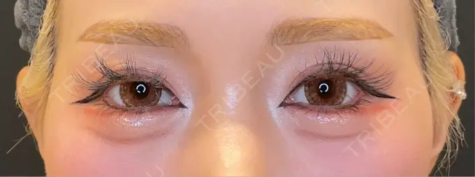 目尻切開 / タレ目形成・グラマラスライン（埋没） LOUIS CLINIC 二子玉川院【ルイクリニック】 AFTER メイン用