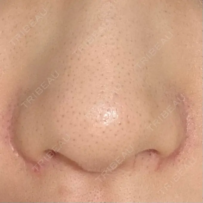 小鼻縮小（切開） GLANZ CLINIC DAY 91 メイン用