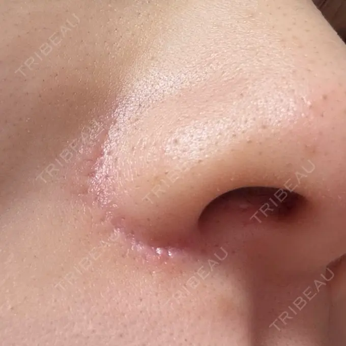 小鼻縮小（切開） GLANZ CLINIC DAY 91 メイン用