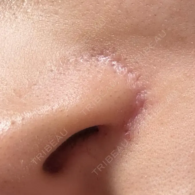 小鼻縮小（切開） GLANZ CLINIC DAY 91 メイン用