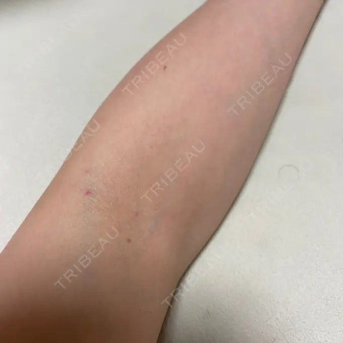 その他（肌） 城本クリニック 立川院 AFTER メイン用