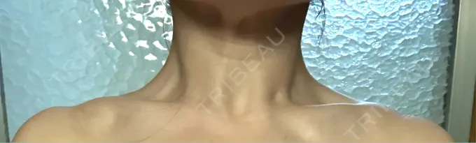 ボトックス（肩） APスキンクリニック銀座 AFTER メイン用