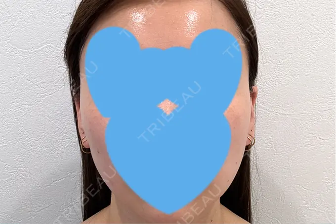 糸リフト / シワ取りボトックス / ボトックス（眉間） アリエル美容クリニック 横浜院 AFTER メイン用