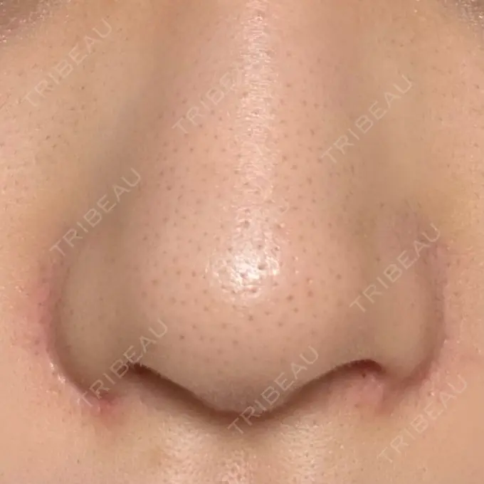 小鼻縮小（切開） GLANZ CLINIC DAY 92 メイン用