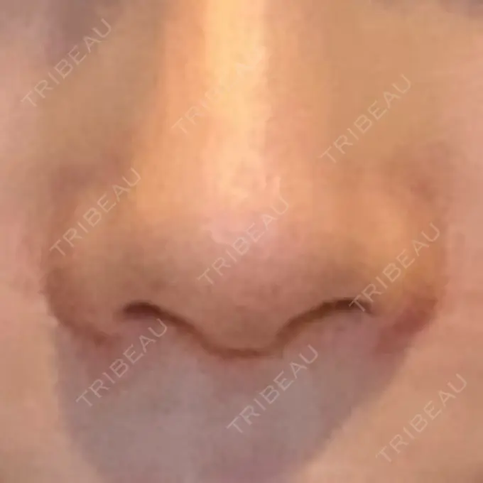 小鼻縮小（切開） GLANZ CLINIC DAY 92 メイン用