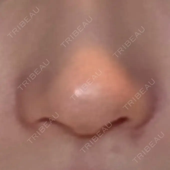 小鼻縮小（切開） GLANZ CLINIC DAY 78 メイン用