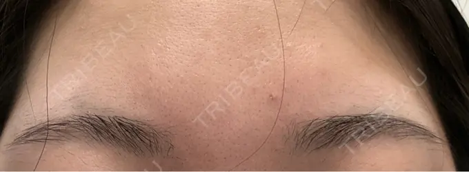 ボトックス（エラ・小顔） / アートメイク（眉） ミケイ医院 DAY 4 メイン用