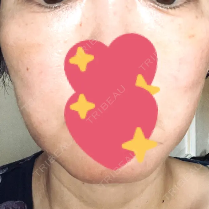 肌育注射（ジュベルックなど） B-LINE CLINIC 大阪院 DAY 11 メイン用