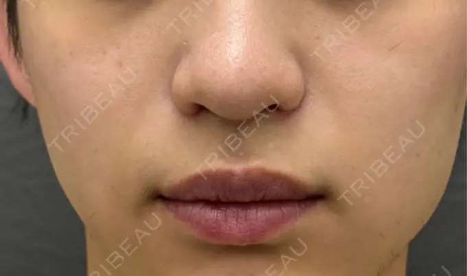 小鼻縮小（切開） 渋谷の森クリニック DAY 21 メイン用