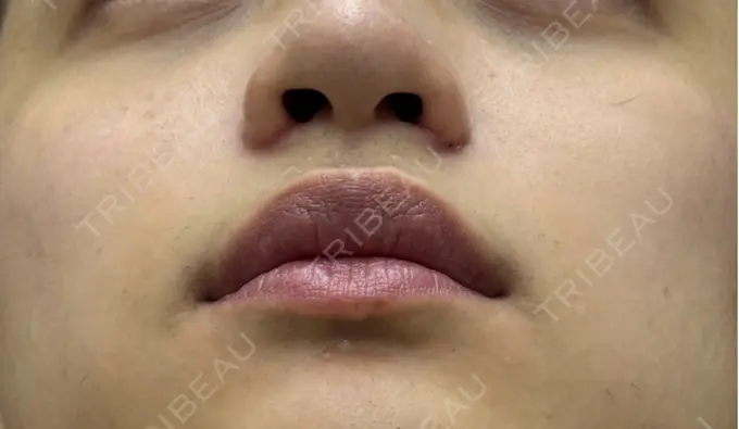 小鼻縮小（切開） 渋谷の森クリニック DAY 21 メイン用