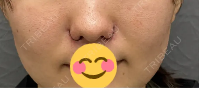 小鼻縮小（切開） 渋谷の森クリニック DAY 0 メイン用