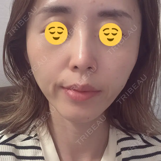 ボトックス（あご） / ボトックス（口角） / ボトックス（眉間） / ボトックス（額） TCB東京中央美容外科 札幌駅前院 DAY 3 メイン用