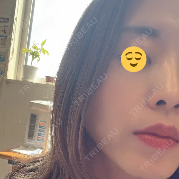 ボトックス（あご） / ボトックス（口角） / ボトックス（眉間） / ボトックス（額） TCB東京中央美容外科 札幌駅前院 DAY 0 メイン用