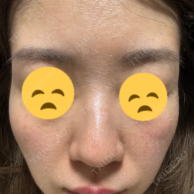 ピーリング（ニキビ・毛穴） / ピコレーザートーニング（美白・肝斑） / ミラノリピール / ピコスポット ビューティー和心クリニック 浅草院 AFTER メイン用