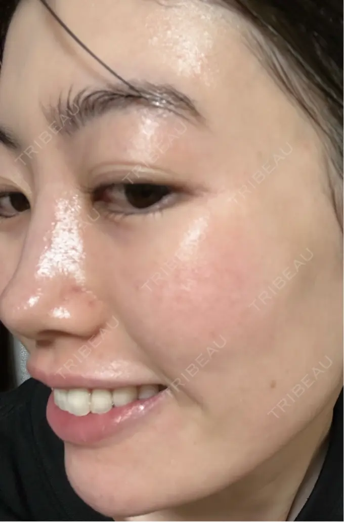 イオン導入 / 光治療（フォトフェイシャルなど） / ピーリング（ハリ・ツヤ） メディアージュクリニック 青山院 DAY 1 メイン用