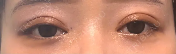 二重埋没 Stand by Beauty Clinic DAY 9 メイン用