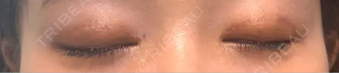 二重埋没 Stand by Beauty Clinic DAY 9 メイン用