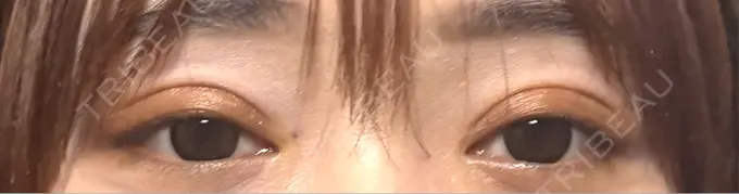 二重埋没 Stand by Beauty Clinic DAY 12 メイン用