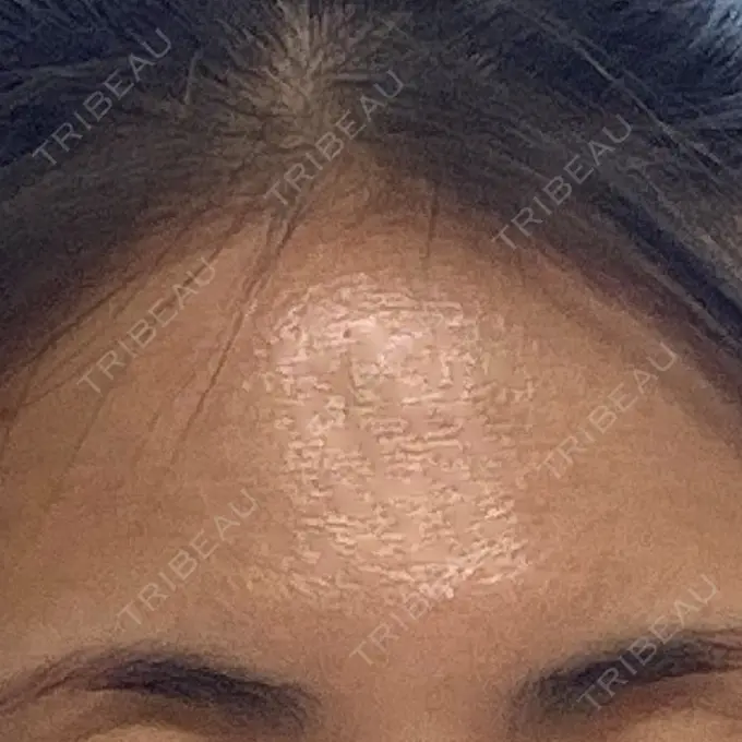 ボトックス（眉間） / ボトックス（額） eクリニック 横浜みなとみらい院 AFTER メイン用