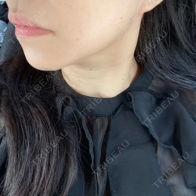 その他（輪郭） ルラ美容クリニック 渋谷本院 AFTER メイン用