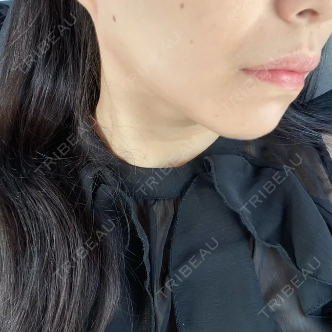 その他（輪郭） ルラ美容クリニック 渋谷本院 DAY 75 メイン用