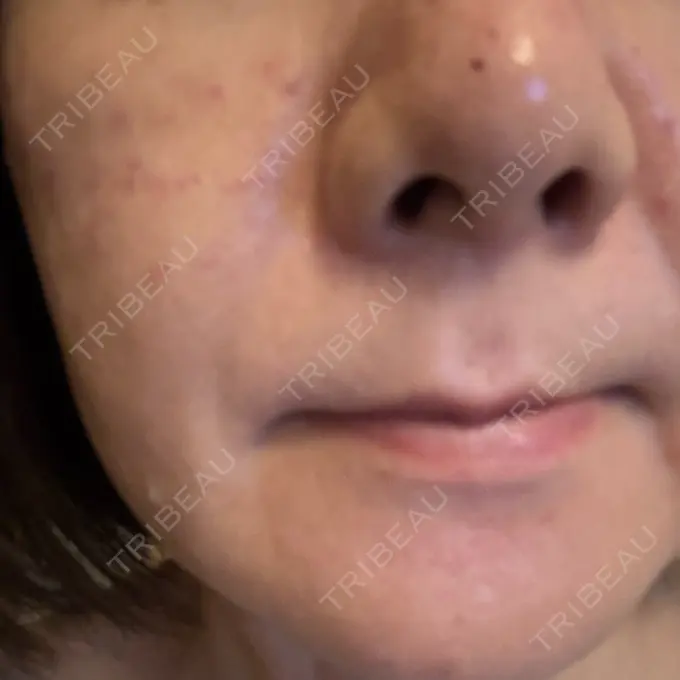 肌育注射（ジュベルックなど） SUNMELIA SKIN CLINIC DAY 0 メイン用