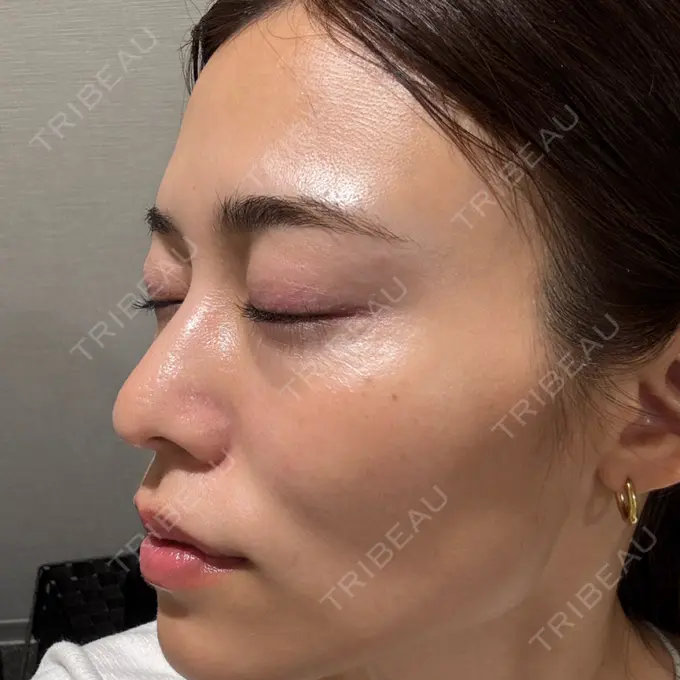 ボトックス（肩） / 肌育注射（ジュベルックなど） APスキンクリニック銀座 DAY 48 メイン用