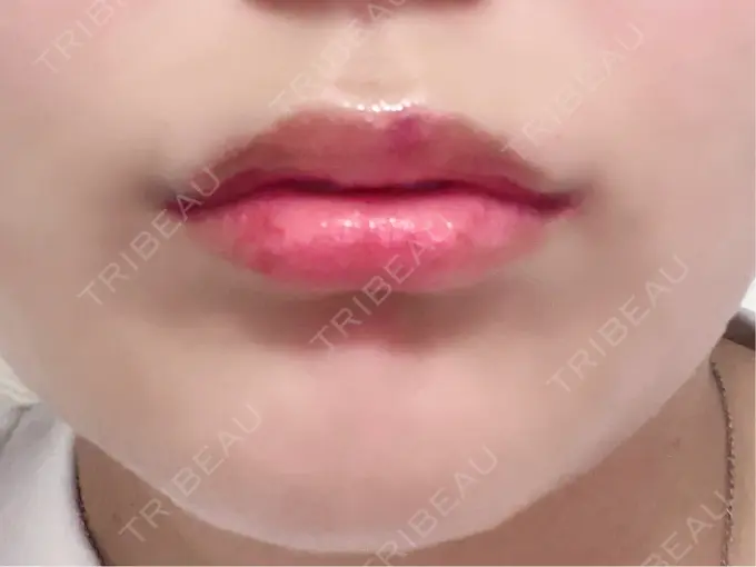 ボトックス（あご） / ヒアルロン酸注入（唇） / ボトックス（口角） / その他（輪郭） ルラ美容クリニック 大阪心斎橋院 DAY 0 メイン用