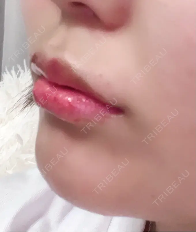 ボトックス（あご） / ヒアルロン酸注入（唇） / ボトックス（口角） / その他（輪郭） ルラ美容クリニック 大阪心斎橋院 DAY 0 メイン用