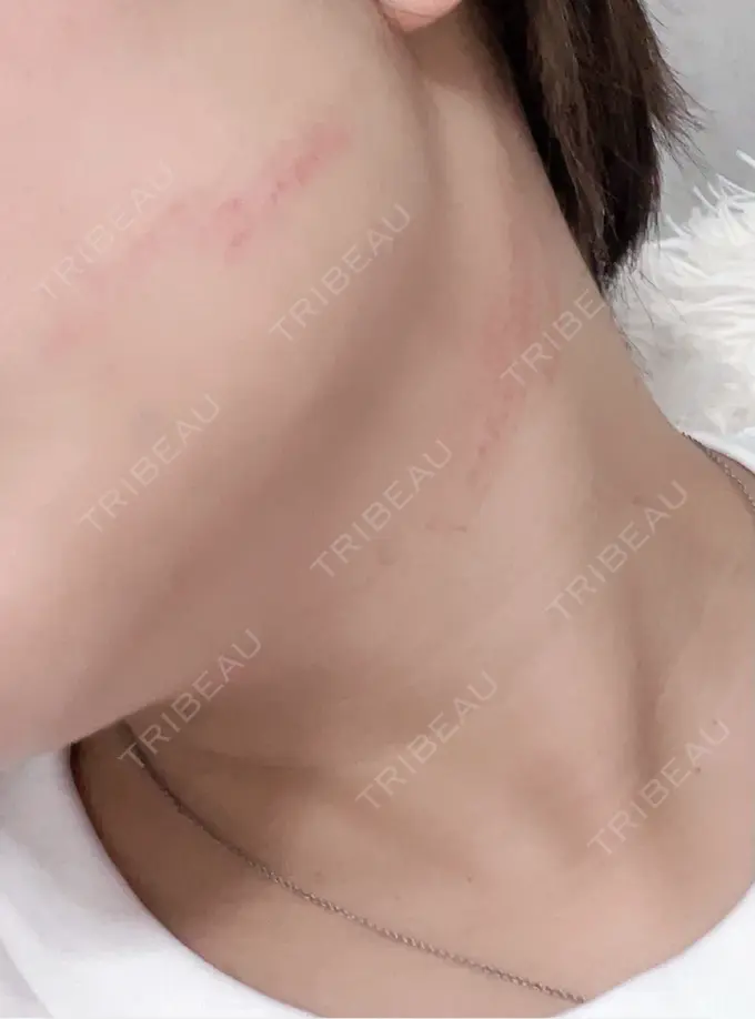 ボトックス（あご） / ヒアルロン酸注入（唇） / ボトックス（口角） / その他（輪郭） ルラ美容クリニック 大阪心斎橋院 DAY 0 メイン用