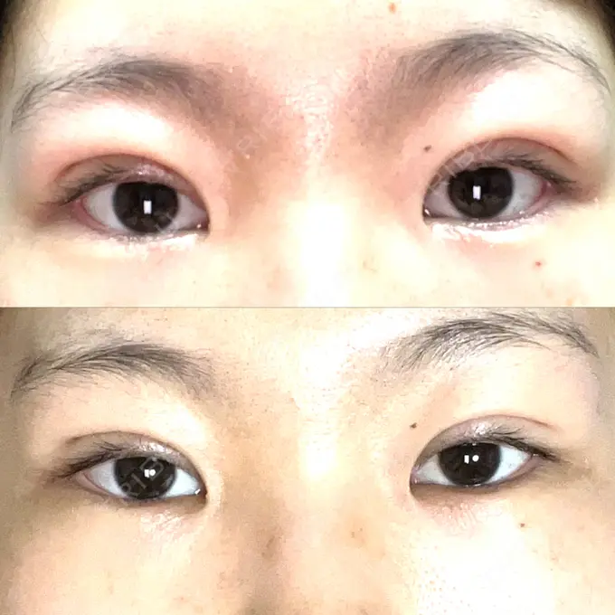 二重埋没 オアシス美容外科 DAY 7 メイン用