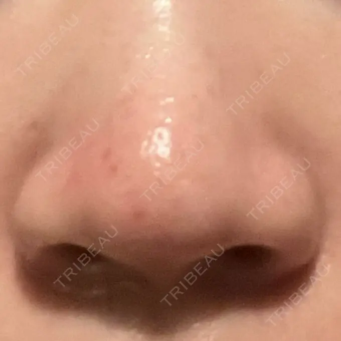 アグネス KM新宿クリニック DAY 11 メイン用