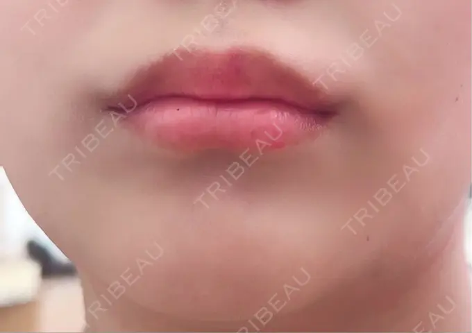 ボトックス（あご） / ヒアルロン酸注入（唇） / ボトックス（口角） / その他（輪郭） ルラ美容クリニック 大阪心斎橋院 DAY 1 メイン用