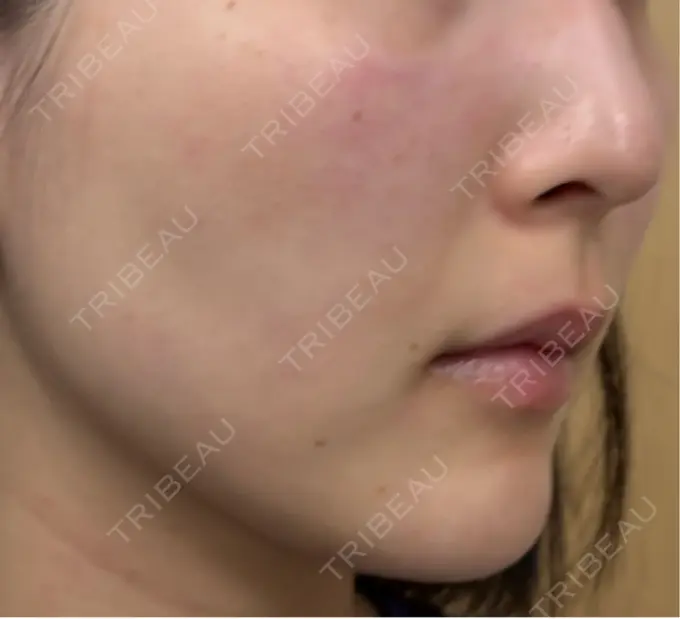 RF（高周波）たるみ治療 共立美容 池袋院 DAY 0 メイン用